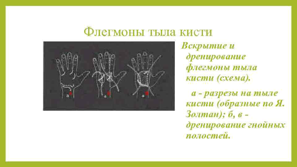 Флегмона кисти карта вызова