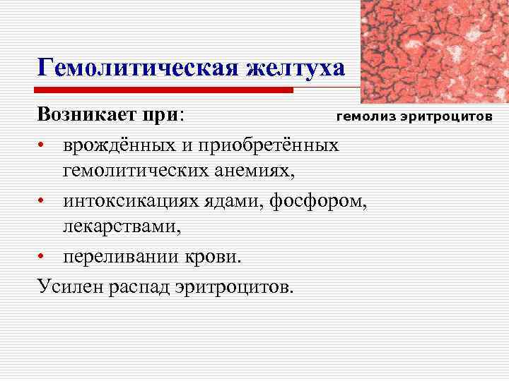 Гемолитическая желтуха Возникает при: гемолиз эритроцитов • врождённых и приобретённых гемолитических анемиях, • интоксикациях