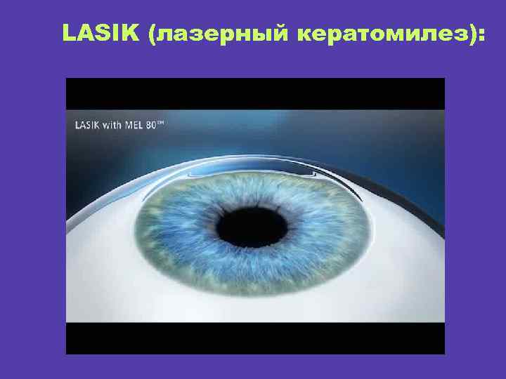 LASIK (лазерный кератомилез): 