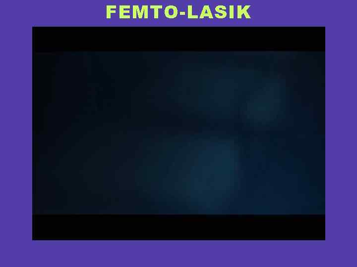 FEMTO-LASIK 