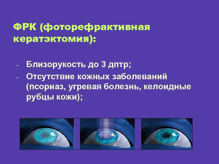ФРК (фоторефрактивная кератэктомия): - Близорукость до 3 дптр; Отсутствие кожных заболеваний (псориаз, угревая болезнь,