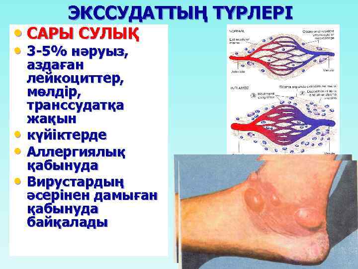 ЭКССУДАТТЫҢ ТҮРЛЕРІ • САРЫ СУЛЫҚ • 3 -5% нәруыз, • • • аздаған лейкоциттер,