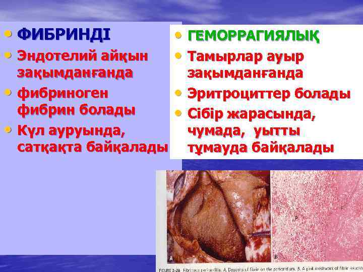  • ФИБРИНДІ • Эндотелий айқын • • зақымданғанда фибриноген фибрин болады Күл ауруында,