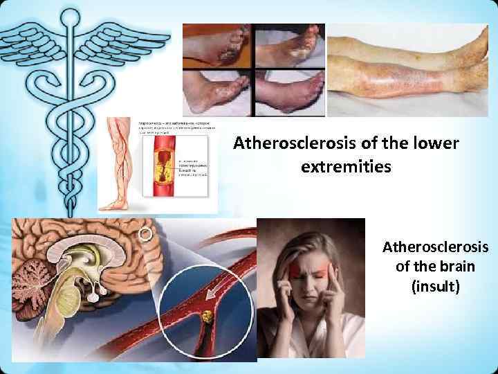Atherosclerosis of the lower extremities Atherosclerosis of the brain (insult) 