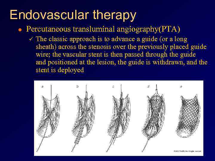 Endovascular therapy l Percutaneous transluminal angiography(PTA) ü The classic approach is to advance a