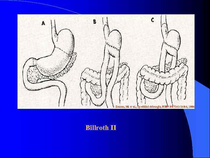 Zeman, M. et al. , Speciální chirurgie, ISBN 80 -7262 -260 -9, 2004 Billroth