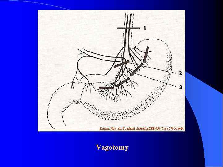 Zeman, M. et al. , Speciální chirurgie, ISBN 80 -7262 -260 -9, 2004 Vagotomy