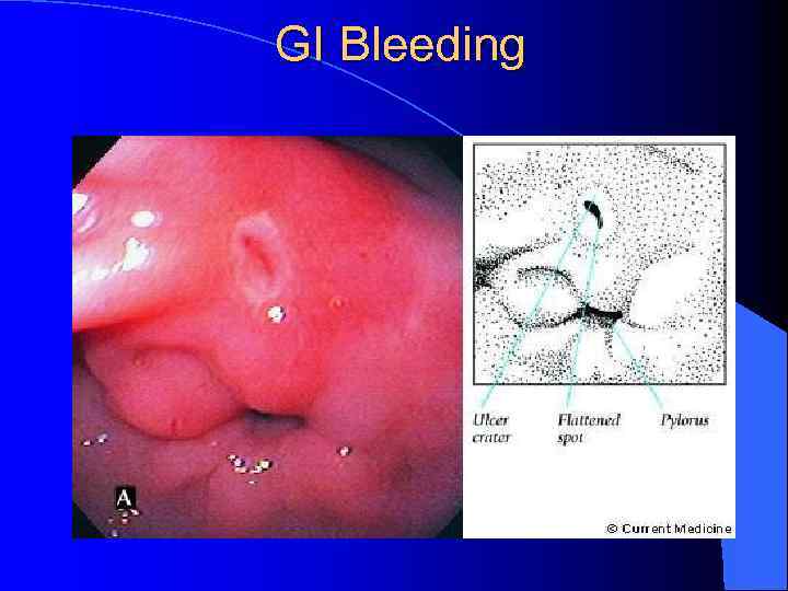 GI Bleeding 