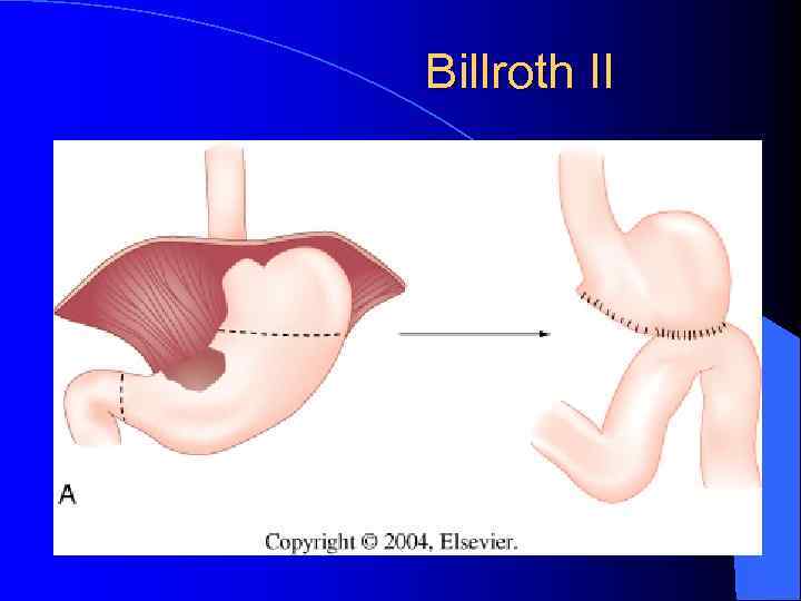 Billroth II 