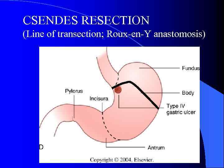 Gastric And Duodenal Ulcer Disease Anatomy Arterial 