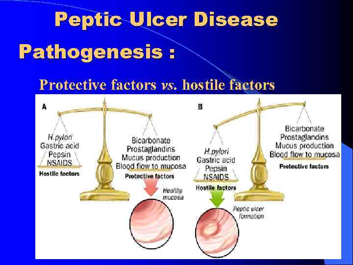 Peptic Ulcer Disease Pathogenesis : Protective factors vs. hostile factors 