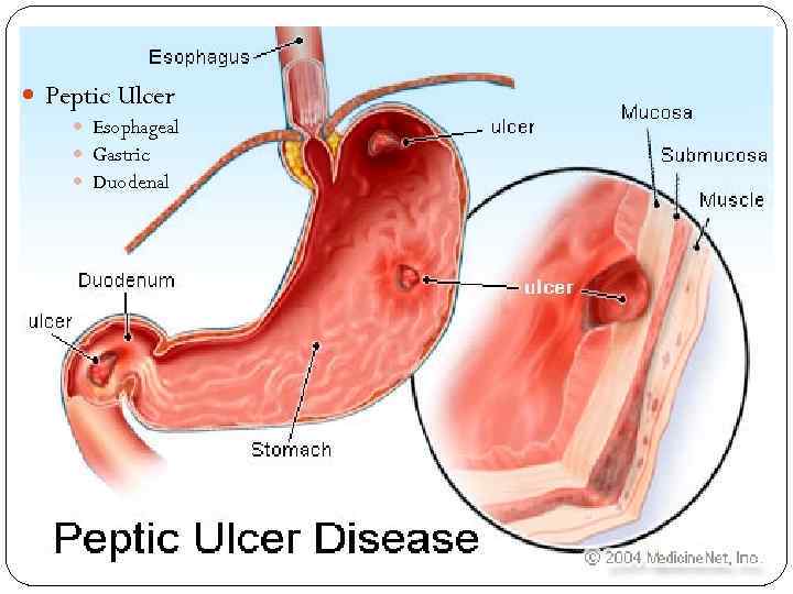  Peptic Ulcer Esophageal Gastric Duodenal 