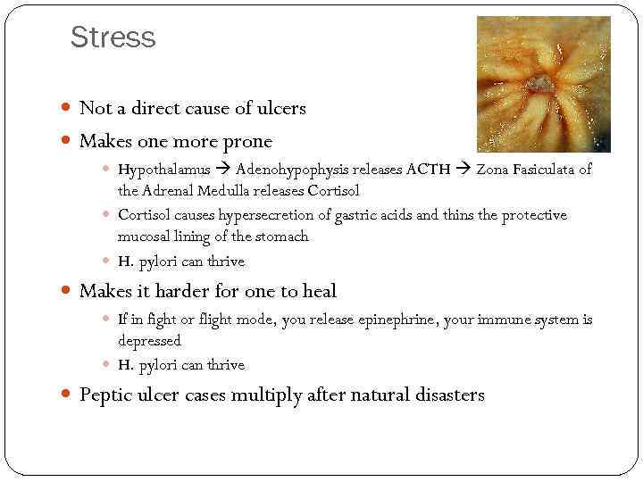 Stress Not a direct cause of ulcers Makes one more prone Hypothalamus Adenohypophysis releases