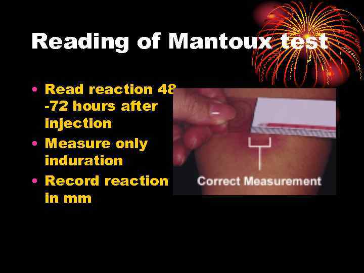 Reading of Mantoux test • Read reaction 48 -72 hours after injection • Measure