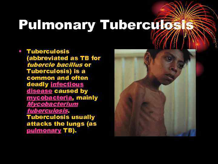 Pulmonary Tuberculosis • Tuberculosis (abbreviated as TB for tubercle bacillus or Tuberculosis) is a