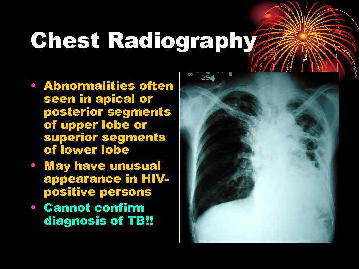 Chest Radiography • Abnormalities often seen in apical or posterior segments of upper lobe