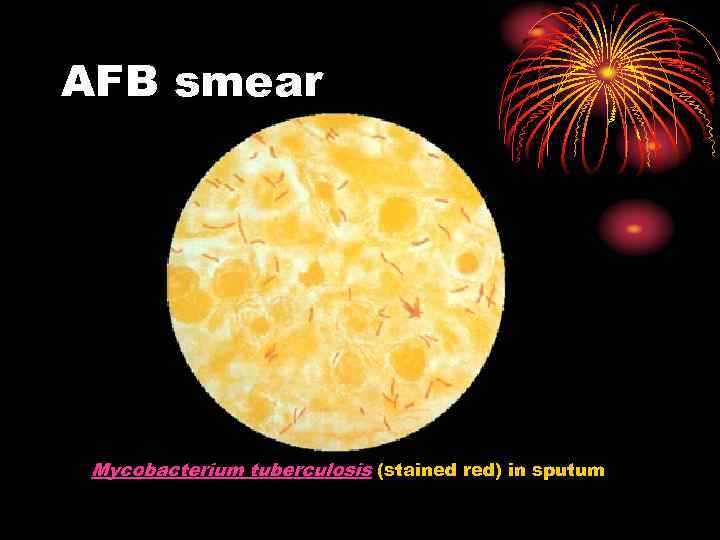 AFB smear Mycobacterium tuberculosis (stained red) in sputum 