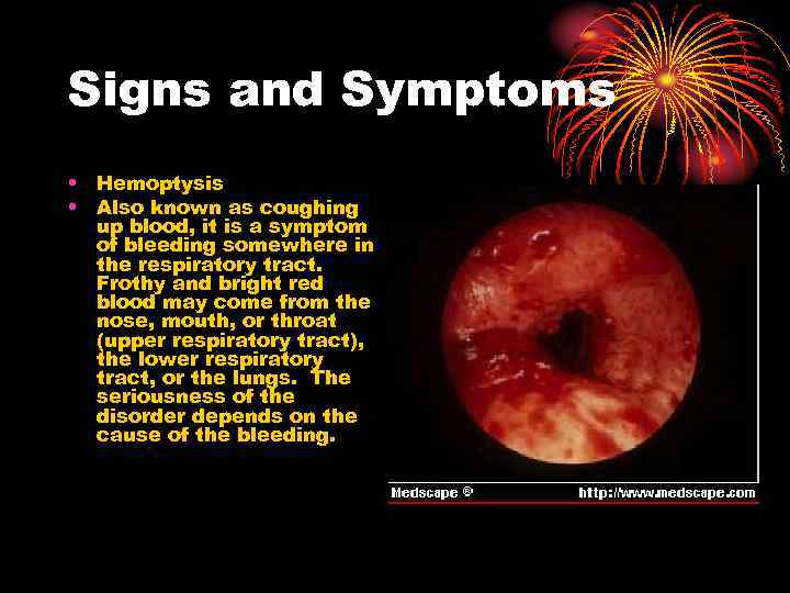 Signs and Symptoms • Hemoptysis • Also known as coughing up blood, it is