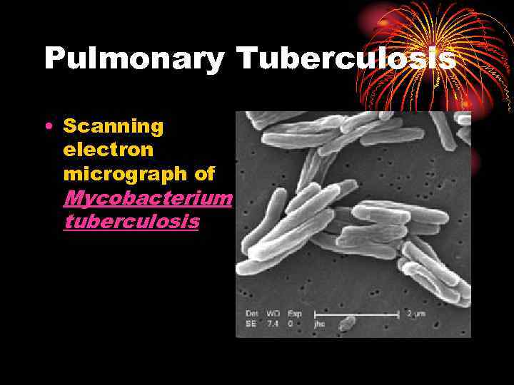 Pulmonary Tuberculosis • Scanning electron micrograph of Mycobacterium tuberculosis 