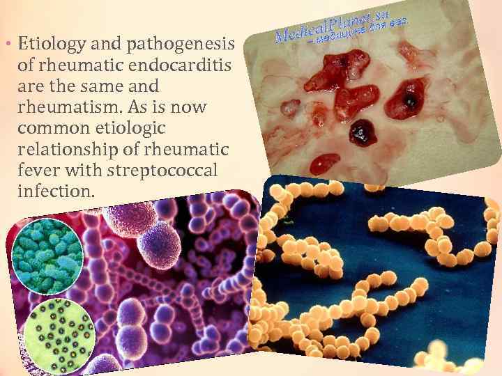 • Etiology and pathogenesis of rheumatic endocarditis are the same and rheumatism. As