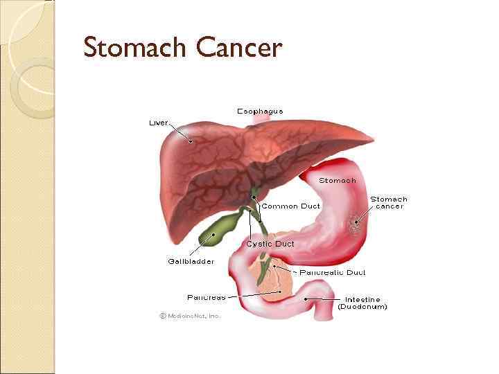 Stomach Cancer 