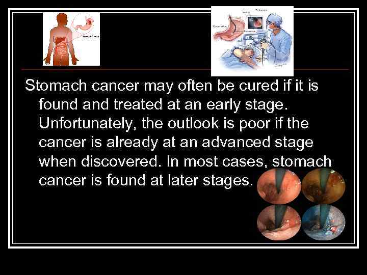 Stomach cancer may often be cured if it is found and treated at an