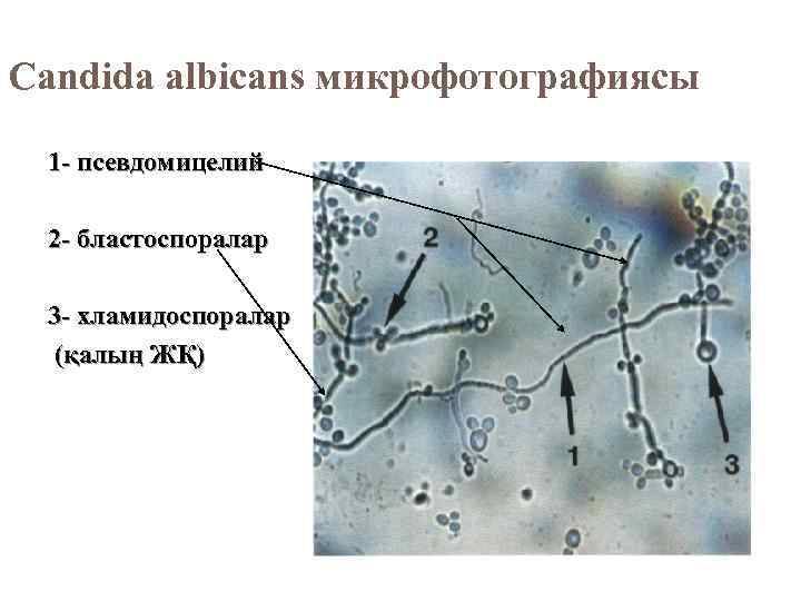Candida albicans микрофотографиясы 1 - псевдомицелий 2 - бластоспоралар 3 - хламидоспоралар (қалың ЖҚ)