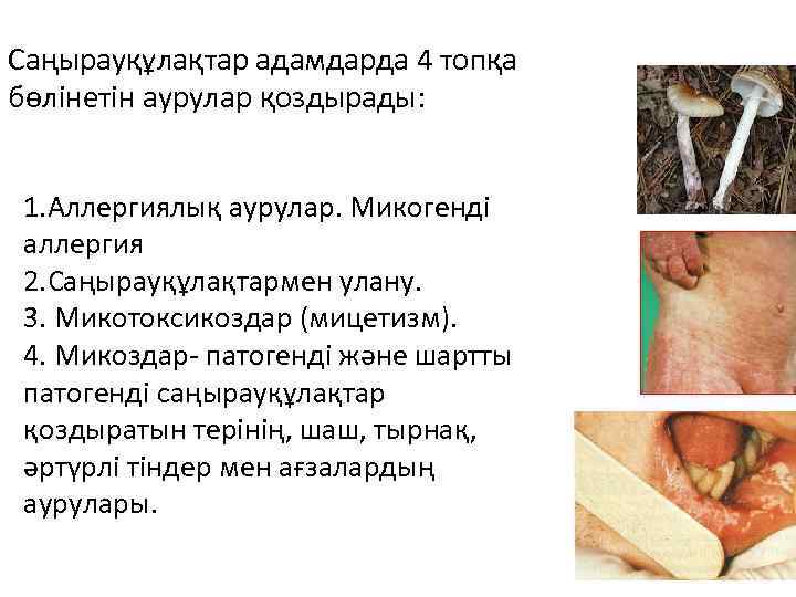 Саңырауқұлақтар адамдарда 4 топқа бөлінетін аурулар қоздырады: 1. Аллергиялық аурулар. Микогенді аллергия 2. Саңырауқұлақтармен