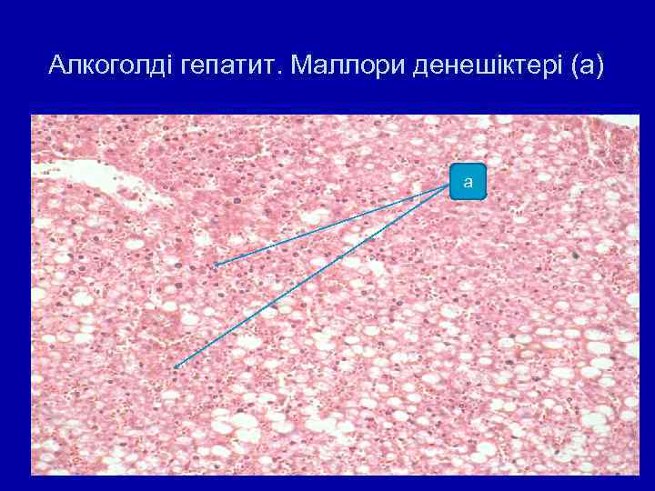 Алкоголді гепатит. Маллори денешіктері (а) а 