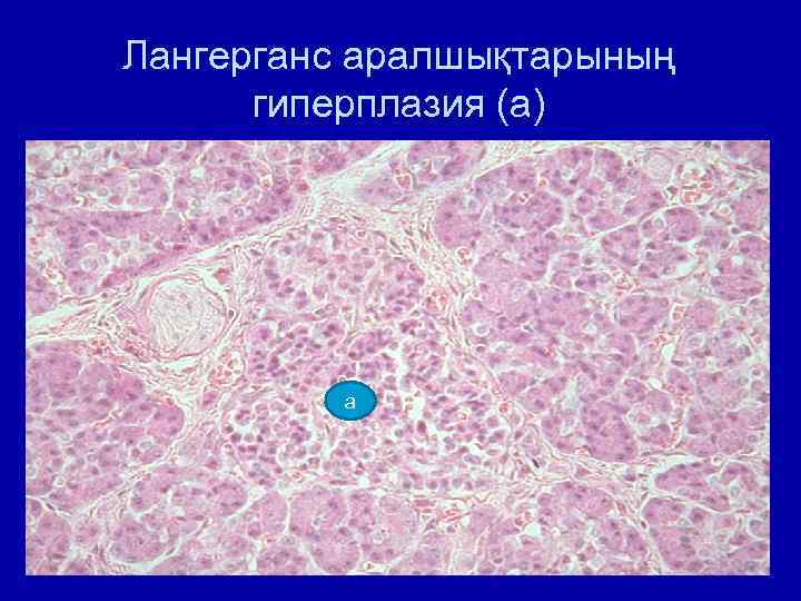 Лангерганс аралшықтарының гиперплазия (а) а 