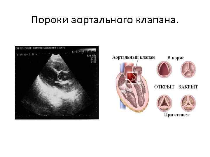 Кальциноз аортального клапана.