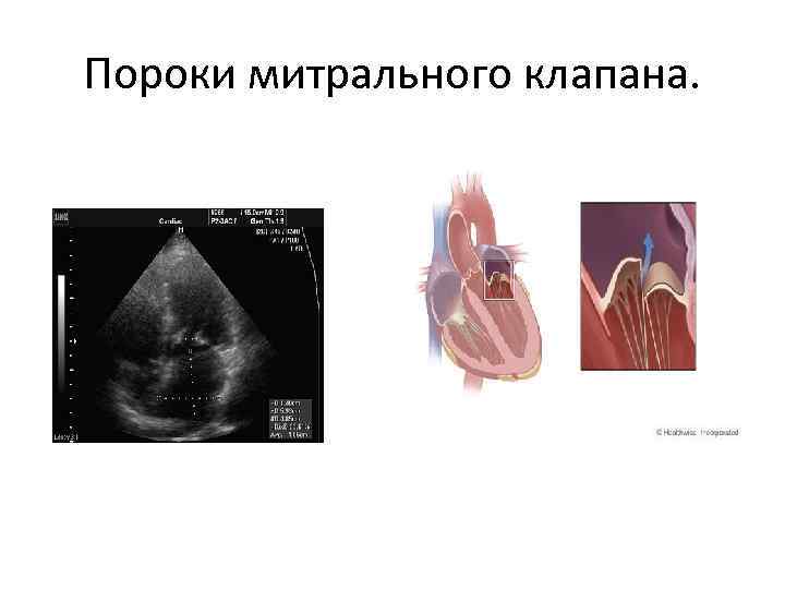 Пороки митрального клапана. 