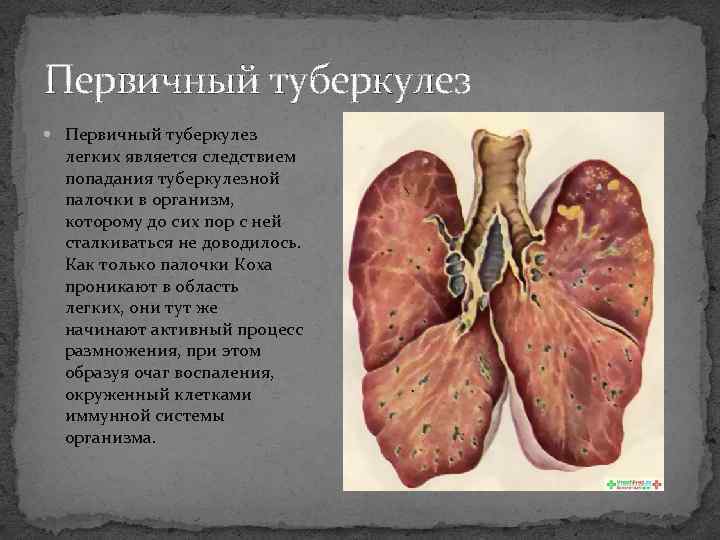 Первичный туберкулез легких является следствием попадания туберкулезной палочки в организм, которому до сих пор