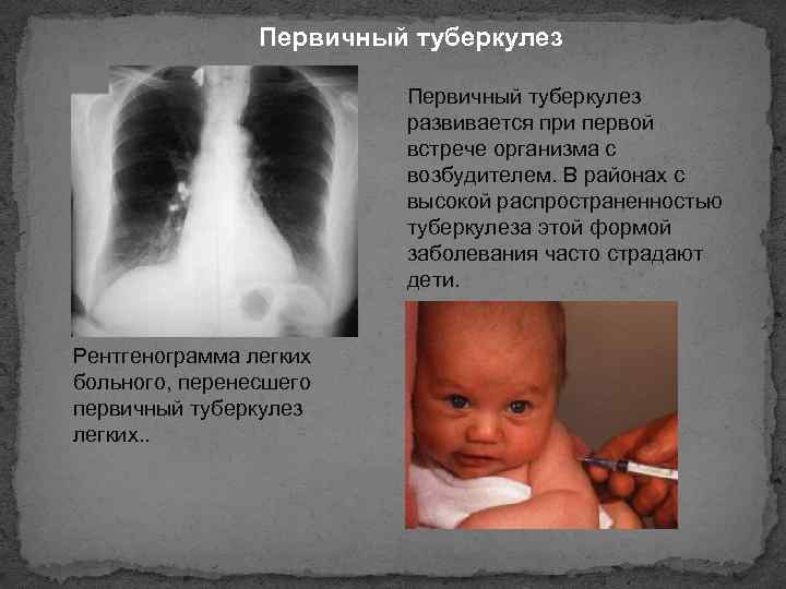 Первичный туберкулез развивается при первой встрече организма с возбудителем. В районах с высокой распространенностью