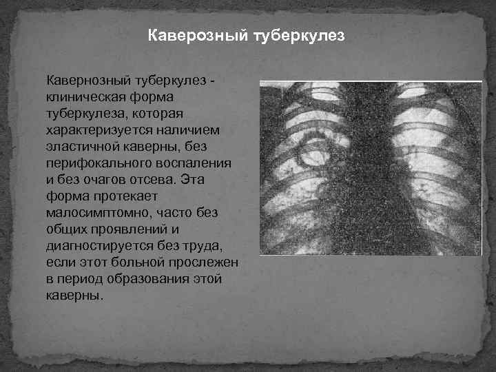 Каверозный туберкулез Кавернозный туберкулез клиническая форма туберкулеза, которая характеризуется наличием эластичной каверны, без перифокального