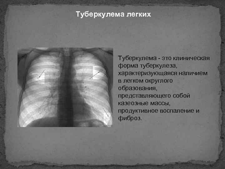 Туберкулема легких Туберкулема - это клиническая форма туберкулеза, характеризующаяся наличием в легком округлого образования,