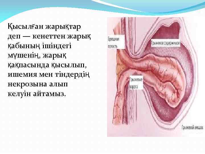 Қысылған жарықтар деп — кенеттен жарық қабының ішіндегі мүшенің, жарық қақпасында қысылып, ишемия мен