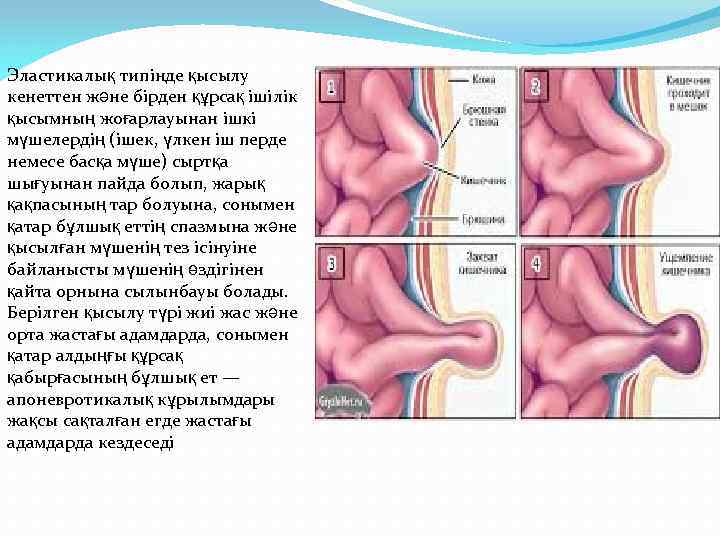 Эластикалық типінде қысылу кенеттен және бірден құрсақ ішілік қысымның жоғарлауынан ішкі мүшелердің (ішек, үлкен