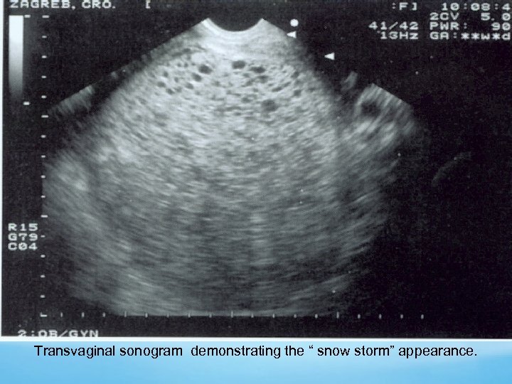 Transvaginal sonogram demonstrating the “ snow storm” appearance. 