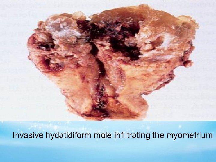 Invasive hydatidiform mole infiltrating the myometrium 