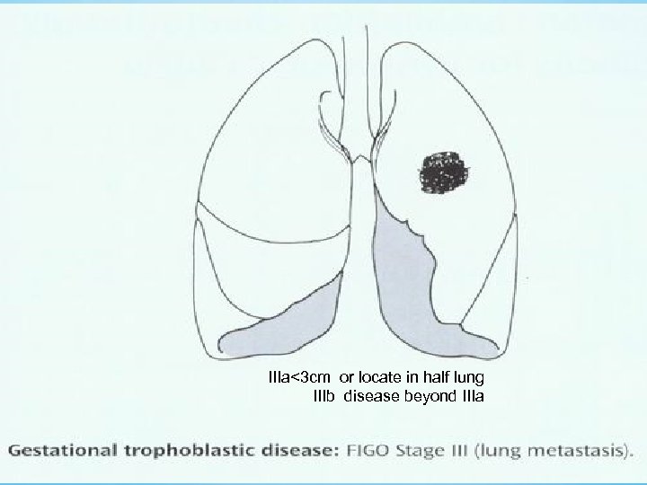 IIIa<3 cm or locate in half lung IIIb disease beyond IIIa 