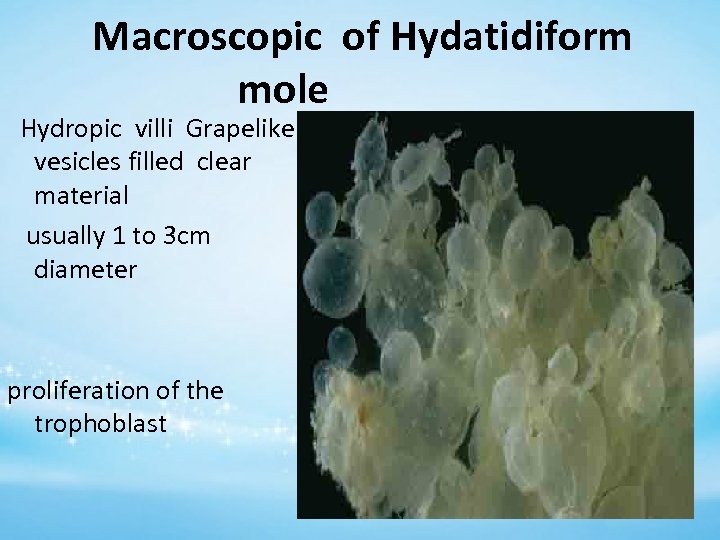Macroscopic of Hydatidiform mole Hydropic villi Grapelike vesicles filled clear material usually 1 to
