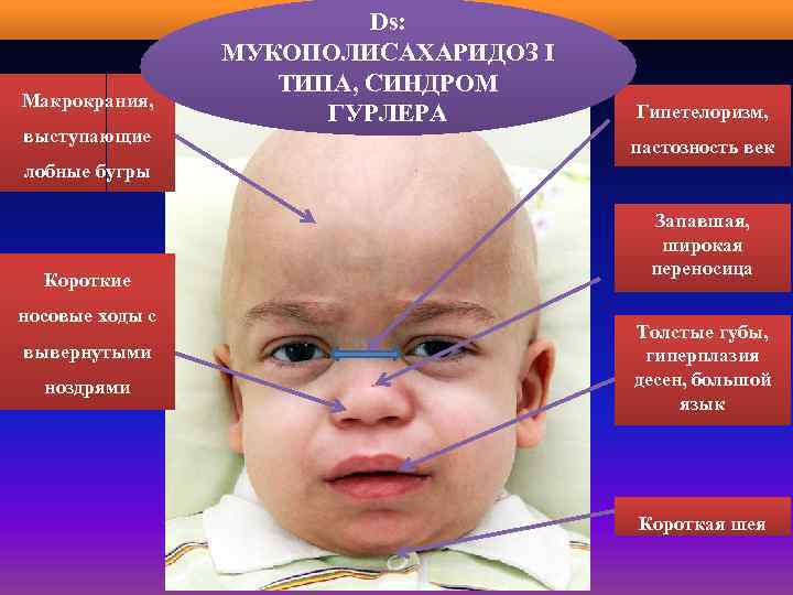 Типа синдром. Мукополисахаридоз 1 типа синдром Гурлера. Мукополисахаридоз 1 типа дети. Болезнь Гурлера мукополисахаридоз. Мукополисахаридозы симптомы.