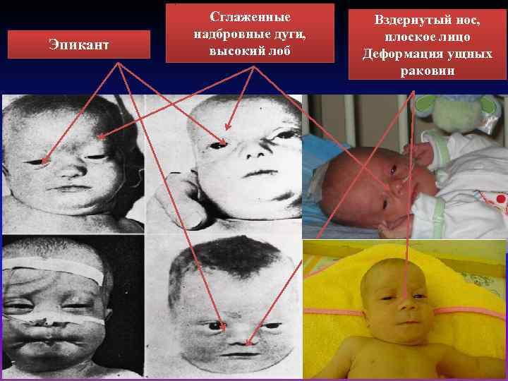 Эпикант Сглаженные надбровные дуги, высокий лоб Вздернутый нос, плоское лицо Деформация ущных раковин 