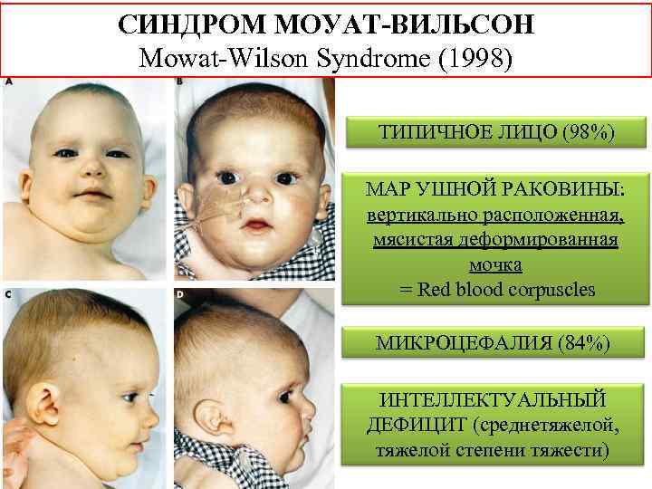 СИНДРОМ МОУАТ-ВИЛЬСОН Mowat-Wilson Syndrome (1998) ТИПИЧНОЕ ЛИЦО (98%) МАР УШНОЙ РАКОВИНЫ: вертикально расположенная, мясистая