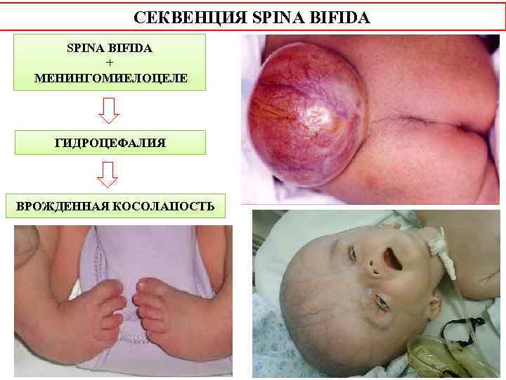 СЕКВЕНЦИЯ SPINA BIFIDA + МЕНИНГОМИЕЛОЦЕЛЕ ГИДРОЦЕФАЛИЯ ВРОЖДЕННАЯ КОСОЛАПОСТЬ 