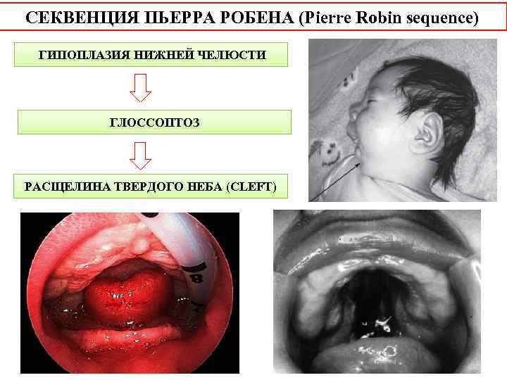 СЕКВЕНЦИЯ ПЬЕРРА РОБЕНА (Pierre Robin sequence) ГИПОПЛАЗИЯ НИЖНЕЙ ЧЕЛЮСТИ ГЛОССОПТОЗ РАСЩЕЛИНА ТВЕРДОГО НЕБА (CLEFT)