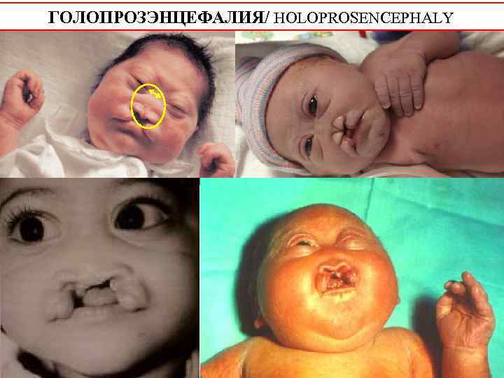 ГОЛОПРОЗЭНЦЕФАЛИЯ/ HOLOPROSENCEPHALY 