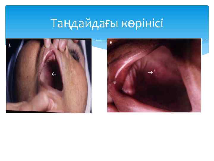 Таңдайдағы көрінісі 