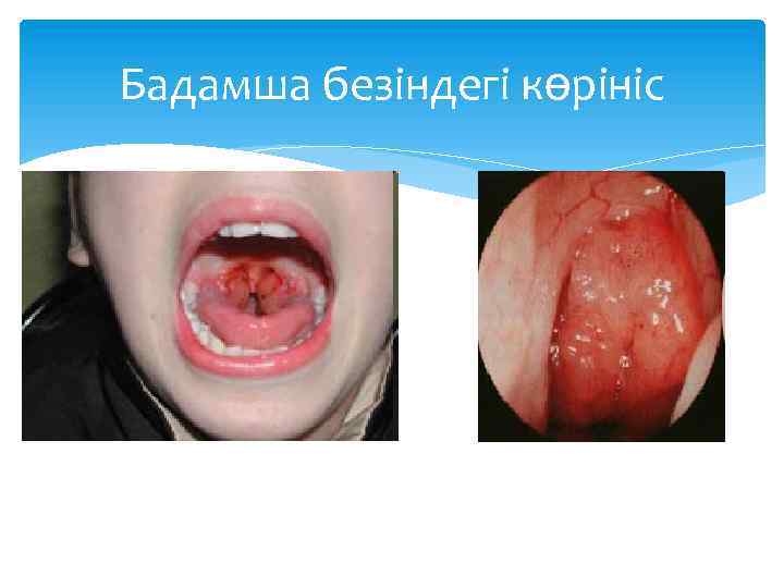 Бадамша безіндегі көрініс 